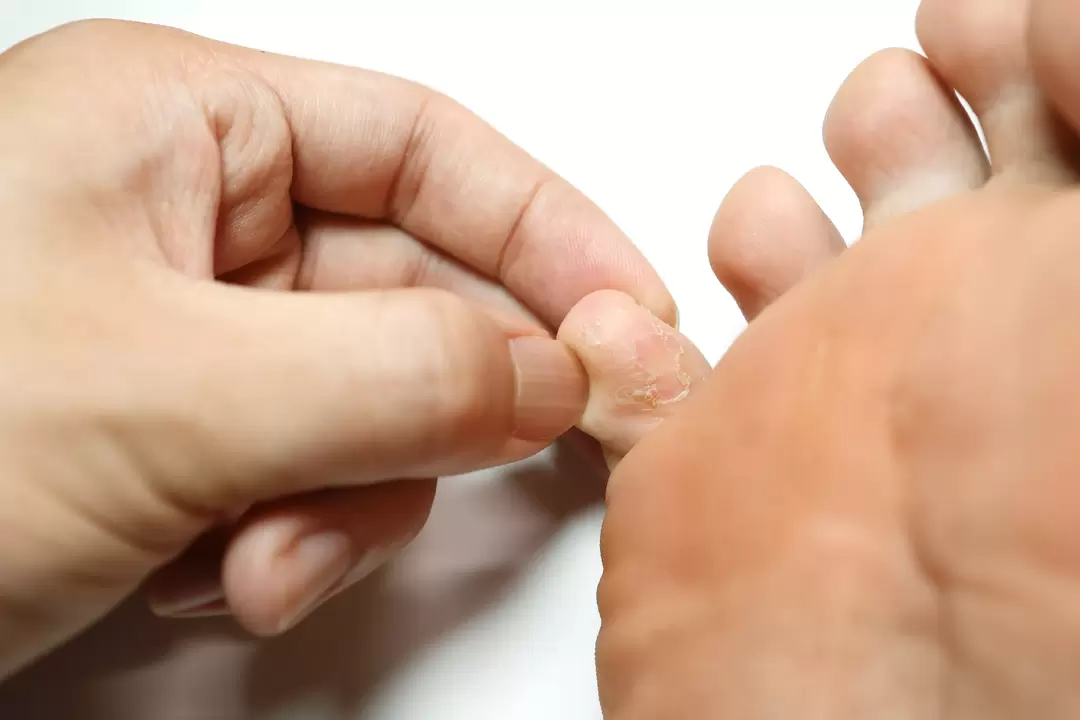 Grybelis ant pirštų ir jo apdorojimas zxcvbnmqwert kremu su kremu