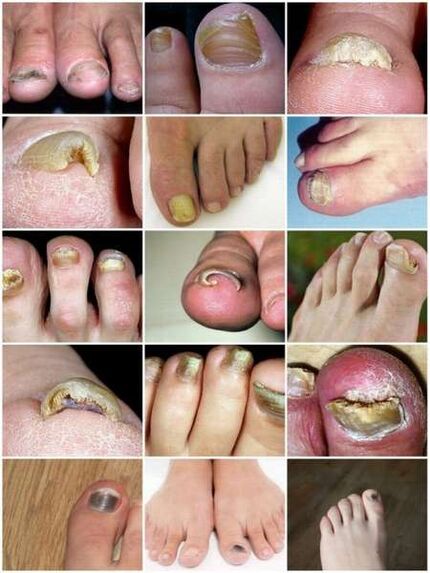 Grybelinė kojų nagų plokštelės infekcija