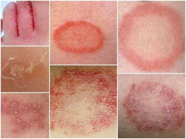 Kojų odos trichofitozė