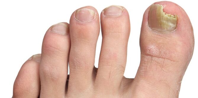 grybelinė nagų plokštelės infekcija